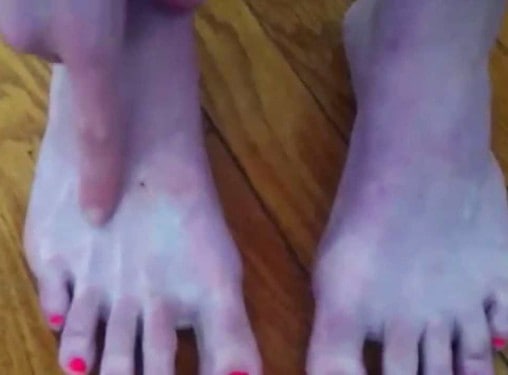 acrocianosis