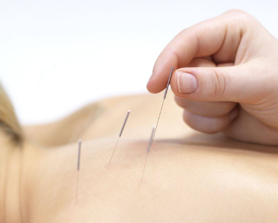 tratamientos de acupuntura para controlar el asma